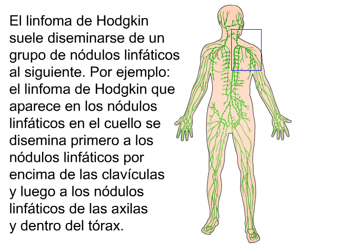 El linfoma de Hodgkin suele diseminarse de un grupo de n�dulos linf�ticos al siguiente. Por ejemplo: el linfoma de Hodgkin que aparece en los n�dulos linf�ticos en el cuello se disemina primero a los n�dulos linf�ticos por encima de las clav�culas y luego a los n�dulos linf�ticos de las axilas y dentro del t�rax.