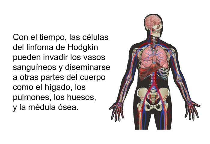 Con el tiempo, las clulas del linfoma de Hodgkin pueden invadir los vasos sanguneos y diseminarse a otras partes del cuerpo como el hgado, los pulmones, los huesos, y la mdula sea.