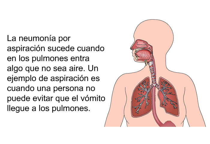 La neumona por aspiracin sucede cuando en los pulmones entra algo que no sea aire. Un ejemplo de aspiracin es cuando una persona no puede evitar que el vmito llegue a los pulmones.