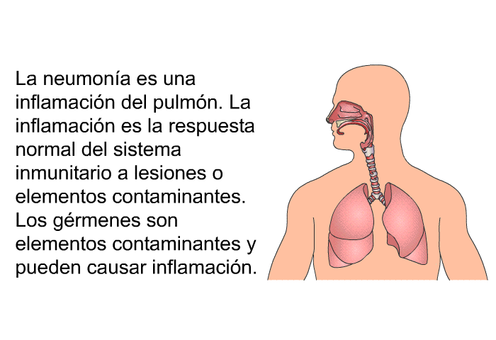 La neumona es una inflamacin del pulmn. La inflamacin es la respuesta normal del sistema inmunitario a lesiones o elementos contaminantes. Los grmenes son elementos contaminantes y pueden causar inflamacin.