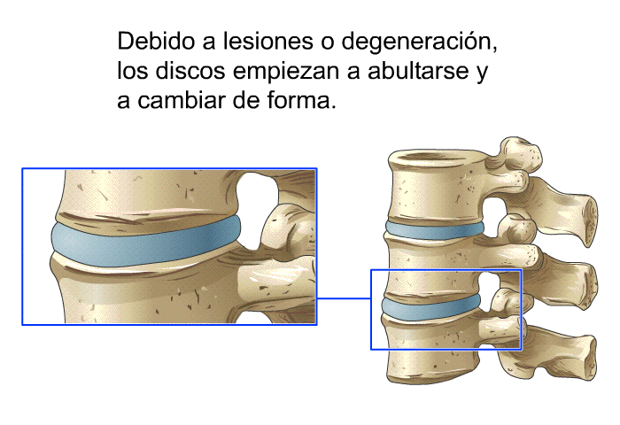 Debido a lesiones o degeneraci�n, los discos empiezan a abultarse y a cambiar de forma.