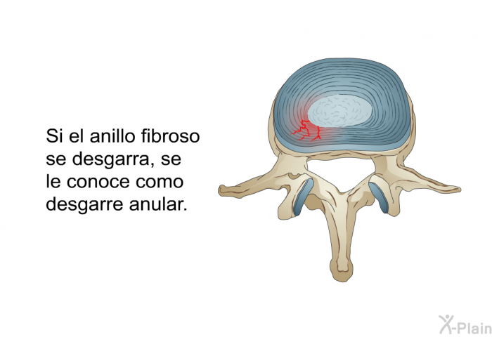 Si el anillo fibroso se desgarra, se le conoce como desgarre anular.