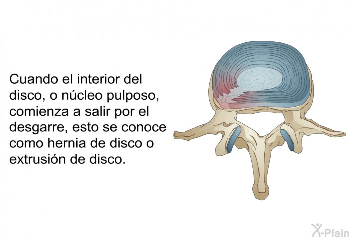Cuando el interior del disco, o n�cleo pulposo, comienza a salir por el desgarre, esto se conoce como hernia de disco o extrusi�n de disco.