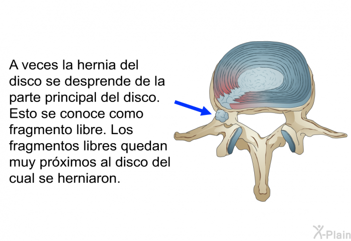 A veces la hernia del disco se desprende de la parte principal del disco. Esto se conoce como fragmento libre. Los fragmentos libres quedan muy pr�ximos al disco del cual se herniaron.