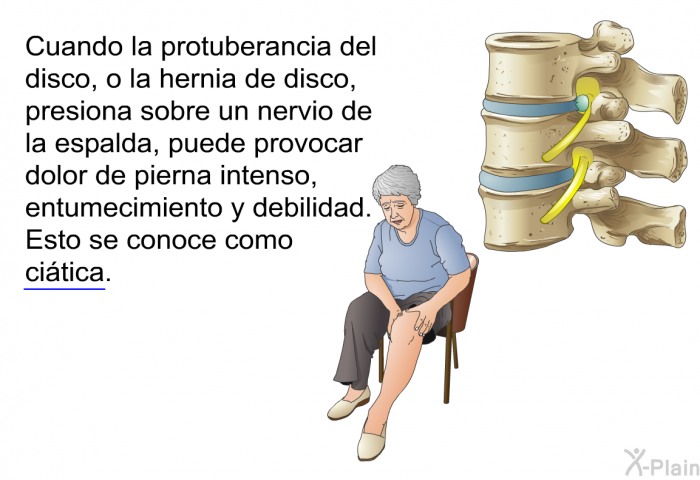 Cuando la protuberancia del disco, o la hernia de disco, presiona sobre un nervio de la espalda, puede provocar dolor de pierna intenso, entumecimiento y debilidad. Esto se conoce como ci�tica.