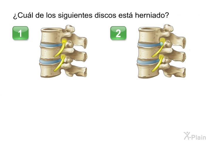 &iquest;Cu�l de los siguientes discos est� herniado?