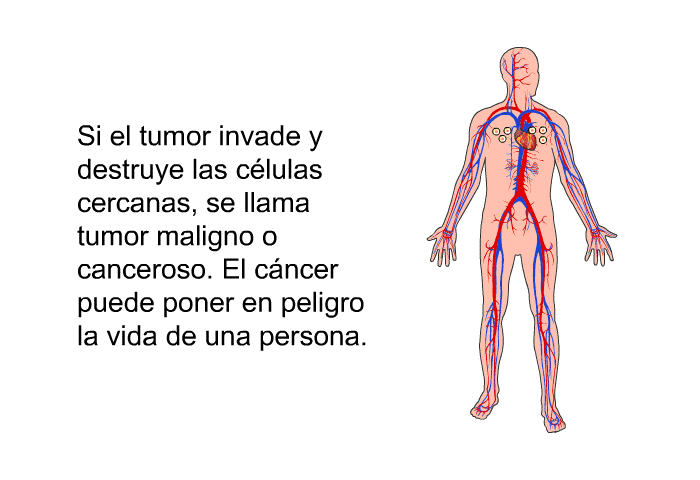 Si el tumor invade y destruye las clulas cercanas, se llama tumor maligno o canceroso. El cncer puede poner en peligro la vida de una persona.