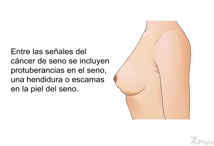 Entre las seales del cncer de seno se incluyen protuberancias en el seno, una hendidura o escamas en la piel del seno.