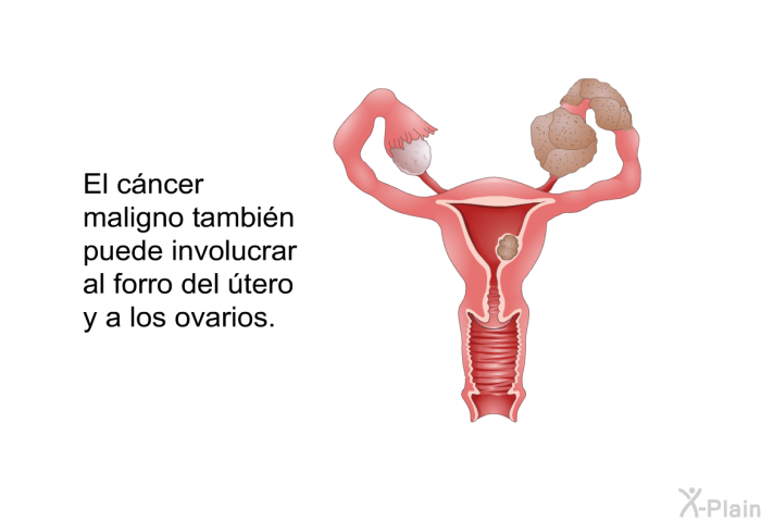 El cncer maligno tambin puede involucrar al forro del tero y a los ovarios.