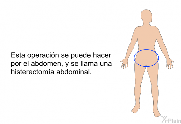 Esta operaci�n se puede hacer por el abdomen, y se llama una histerectom�a abdominal.