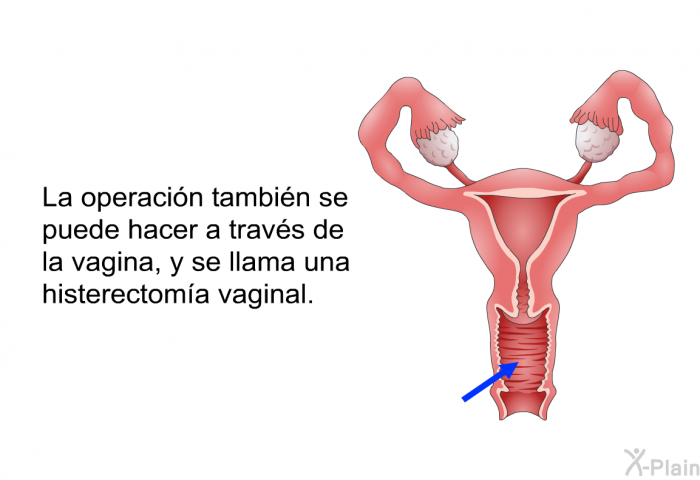 La operaci�n tambi�n se puede hacer a trav�s de la vagina, y se llama una histerectom�a vaginal.