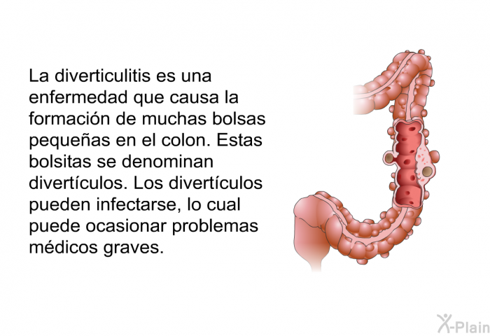 La diverticulitis es una enfermedad que causa la formacin de muchas bolsas pequeas en el colon. Estas bolsitas se denominan divertculos. Los divertculos pueden infectarse, lo cual puede ocasionar problemas mdicos graves.