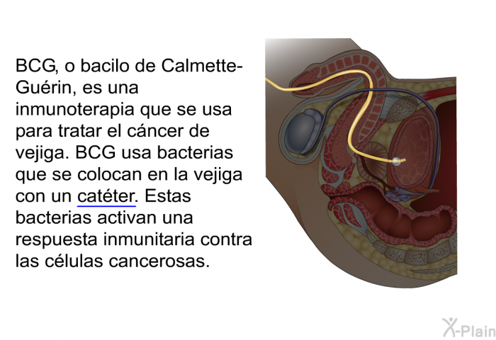 BCG, o bacilo de Calmette-Gurin, es una inmunoterapia que se usa para tratar el cncer de vejiga. BCG usa bacterias que se colocan en la vejiga con un <U>catter</U>. Estas bacterias activan una respuesta inmunitaria contra las clulas cancerosas.