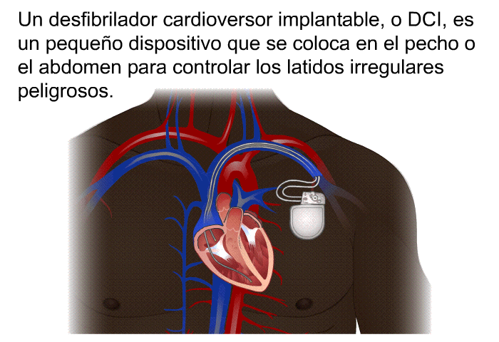 Un desfibrilador cardioversor implantable, o DCI, es un pequeo dispositivo que se coloca en el pecho o el abdomen para controlar los latidos irregulares peligrosos.