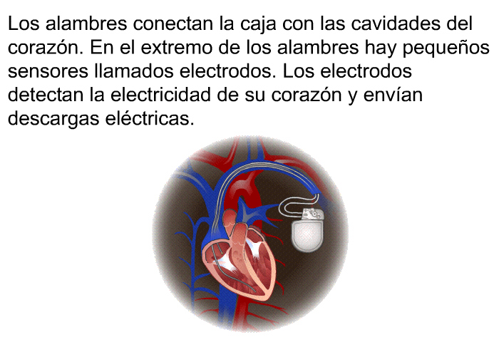 Los alambres conectan la caja con las cavidades del corazn. En el extremo de los alambres hay pequeos sensores llamados electrodos. Los electrodos detectan la electricidad de su corazn y envan descargas elctricas. 