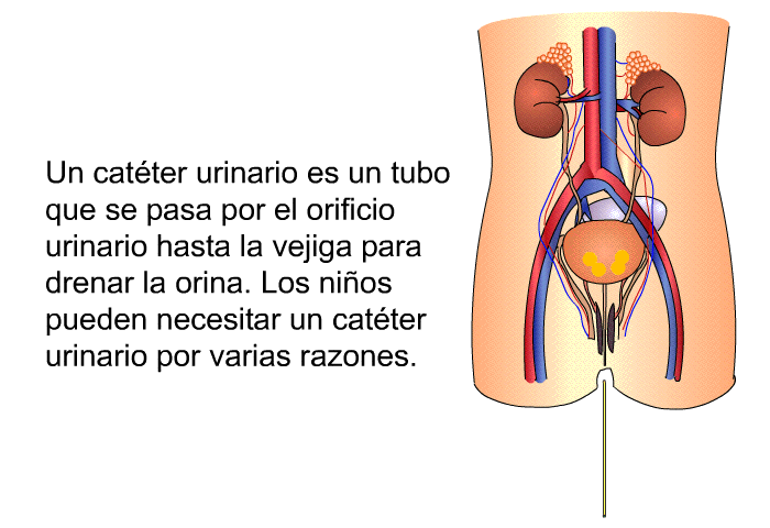 Un catter urinario es un tubo que se pasa por el orificio urinario hasta la vejiga para drenar la orina. Los nios pueden necesitar un catter urinario por varias razones.
