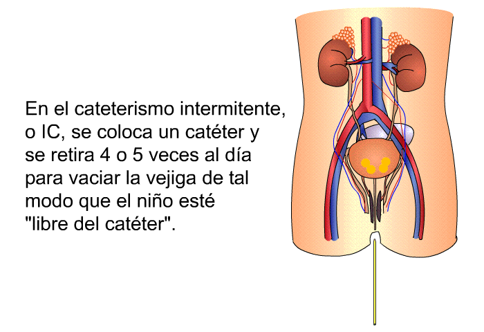 En el cateterismo intermitente, o IC, se coloca un catter y se retira 4 o 5 veces al da para vaciar la vejiga de tal modo que el nio est “libre del catter”.