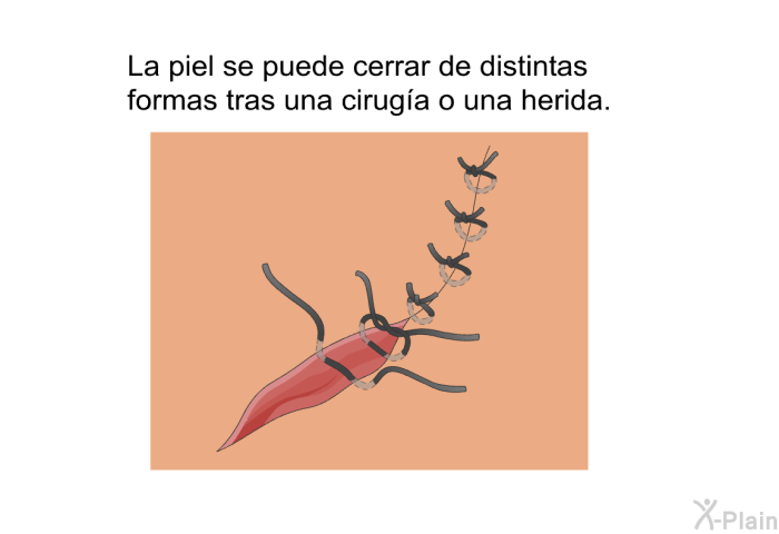 La piel se puede cerrar de distintas formas tras una ciruga o una herida.