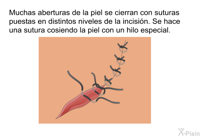 Muchas aberturas de la piel se cierran con suturas puestas en distintos niveles de la incisin. Se hace una sutura cosiendo la piel con un hilo especial.