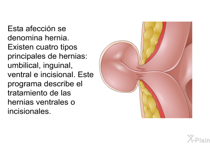 Esta afeccin se denomina hernia. Existen cuatro tipos principales de hernias: umbilical, inguinal, ventral e incisional. Este programa describe el tratamiento de las hernias ventrales o incisionales.