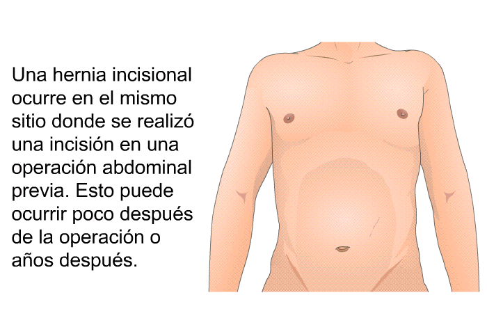 Una hernia incisional ocurre en el mismo sitio donde se realiz una incisin en una operacin abdominal previa. Esto puede ocurrir poco despus de la operacin o aos despus.