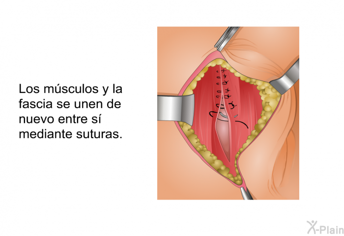 Los m�sculos y la fascia se unen de nuevo entre s� mediante suturas.