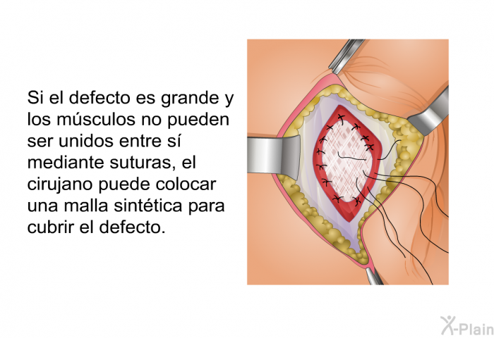 Si el defecto es grande y los m�sculos no pueden ser unidos entre s� mediante suturas, el cirujano puede colocar una malla sint�tica para cubrir el defecto.