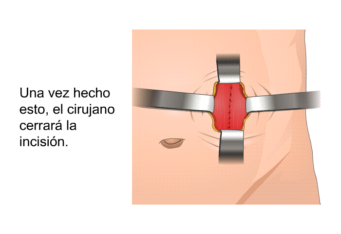 Una vez hecho esto, el cirujano cerrar� la incisi�n.