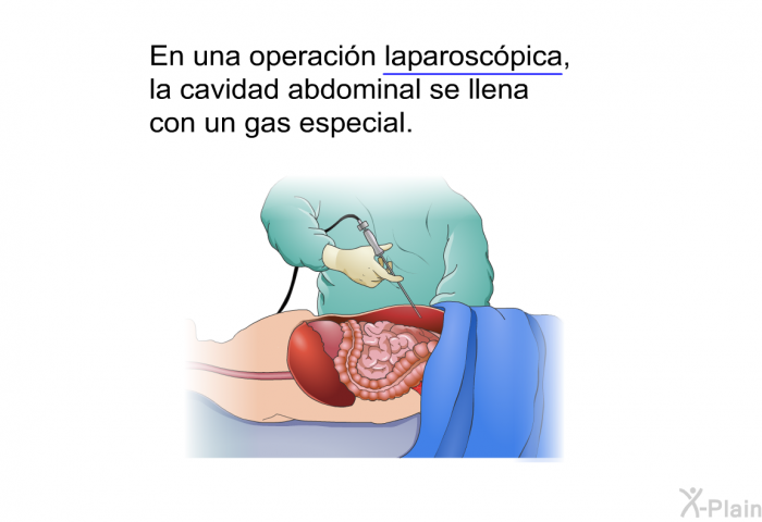 En una operaci�n laparosc�pica, la cavidad abdominal se llena con un gas especial.