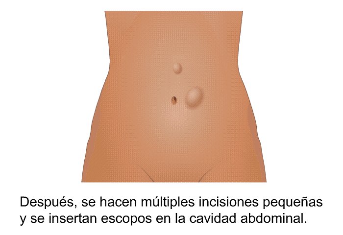 Despu�s, se hacen m�ltiples incisiones peque�as y se insertan escopos en la cavidad abdominal.
