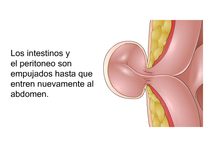 Los intestinos y el peritoneo son empujados hasta que entren nuevamente al abdomen.