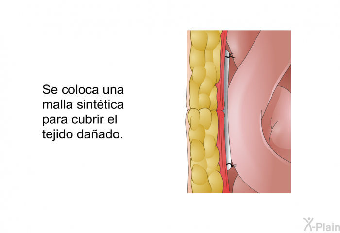 Se coloca una malla sinttica para cubrir el tejido daado.