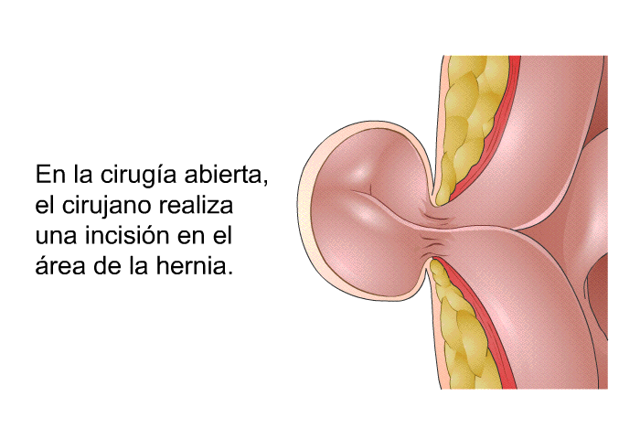 En la cirug�a abierta, el cirujano realiza una incisi�n en el �rea de la hernia.