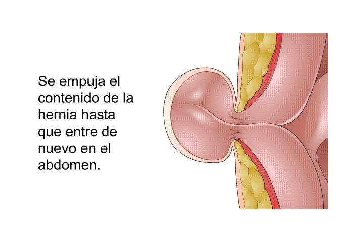 Se empuja el contenido de la hernia hasta que entre de nuevo en el abdomen.