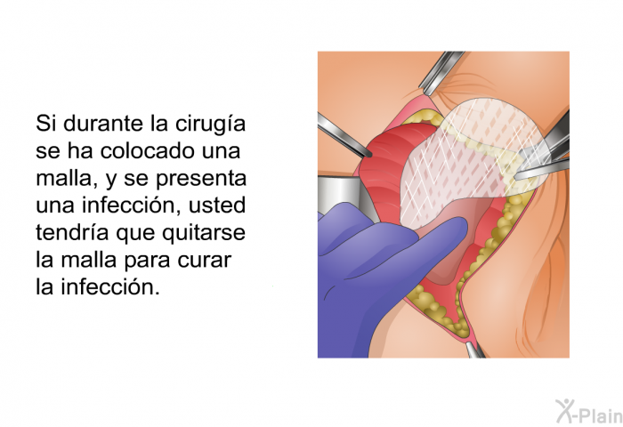 Si durante la ciruga se ha colocado una malla, y se presenta una infeccin, usted tendra que quitarse la malla para curar la infeccin.