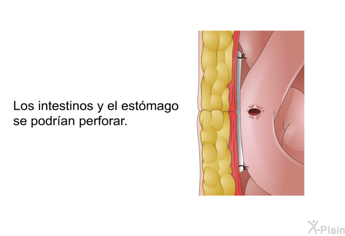 Los intestinos y el estmago se podran perforar.