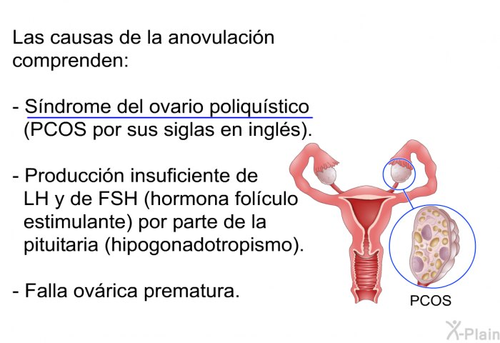 Las causas de la anovulacin comprenden:  Sndrome del ovario poliqustico (PCOS por sus siglas en ingls). Produccin insuficiente de LH y de FSH (hormona folculo estimulante) por parte de la pituitaria (hipogonadotropismo). Falla ovrica prematura.