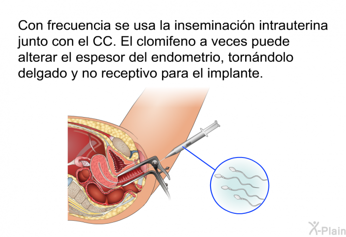 Con frecuencia se usa la inseminaci�n intrauterina junto con el CC. El clomifeno a veces puede alterar el espesor del endometrio, torn�ndolo delgado y no receptivo para el implante.