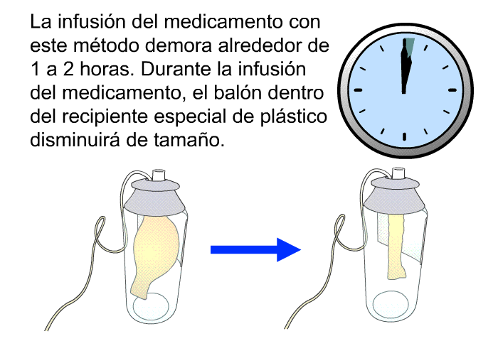 La infusin del medicamento con este mtodo demora alrededor de 1 a 2 horas. Durante la infusin del medicamento, el baln dentro del recipiente especial de plstico disminuir de tamao.