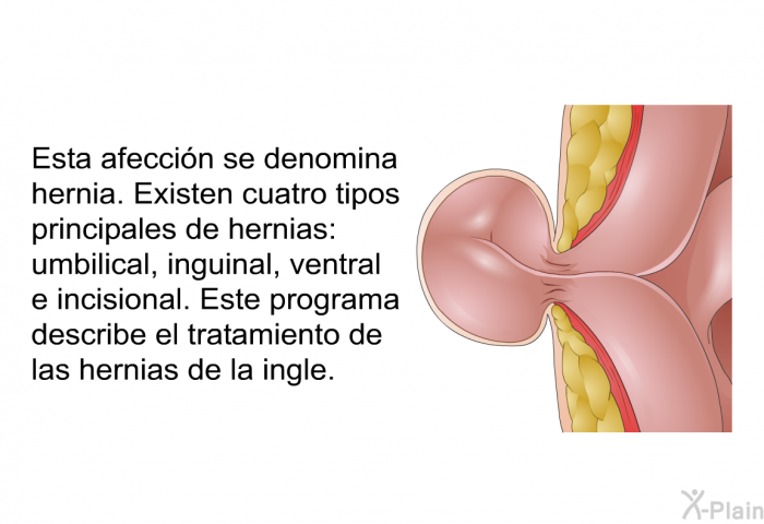 Esta afeccin se denomina hernia. Existen cuatro tipos principales de hernias: umbilical, inguinal, ventral e incisional. Este programa describe el tratamiento de las hernias de la ingle.