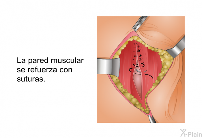 La pared muscular se refuerza con suturas.