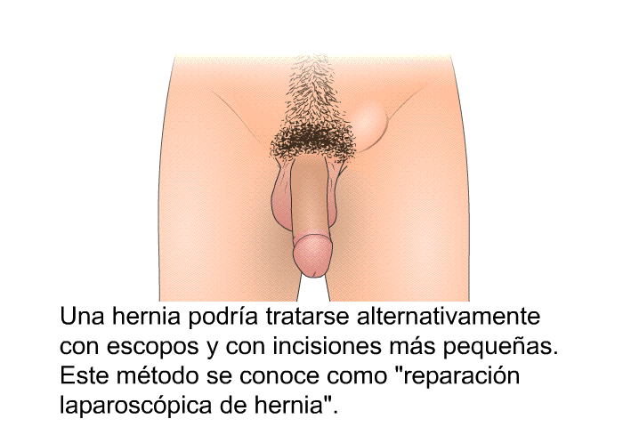 Una hernia podra tratarse alternativamente con escopos y con incisiones ms pequeas. Este mtodo se conoce como “reparacin laparoscpica de hernia”.