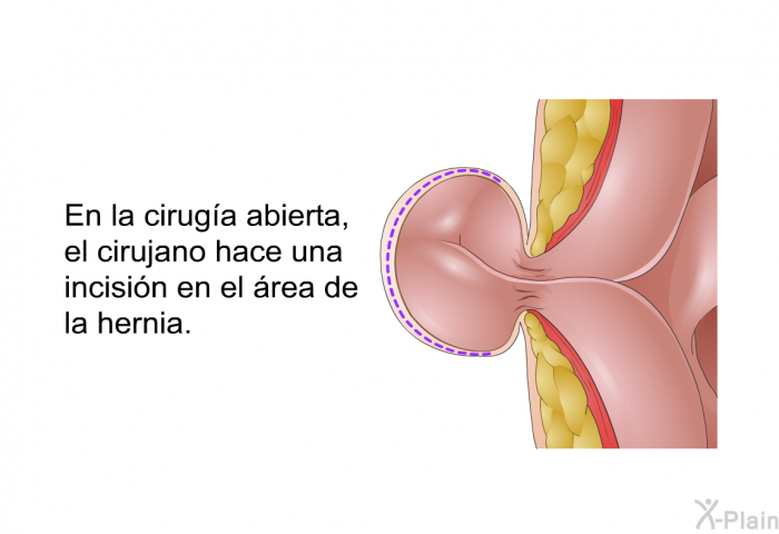 En la ciruga abierta, el cirujano hace una incisin en el rea de la hernia.