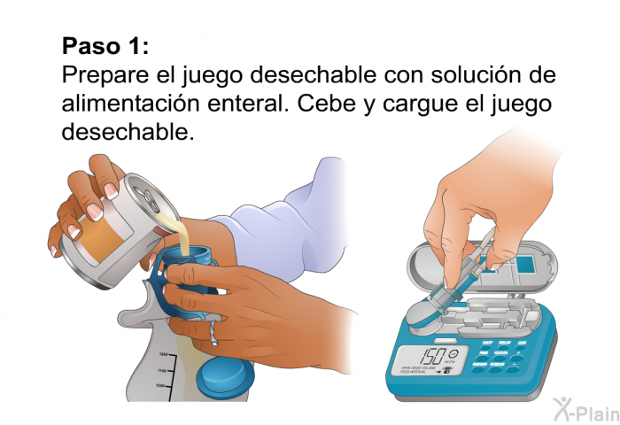 <B>Paso 1:</B> 
 Prepare el juego desechable con solucin de alimentacin enteral. Cebe y cargue el juego desechable.