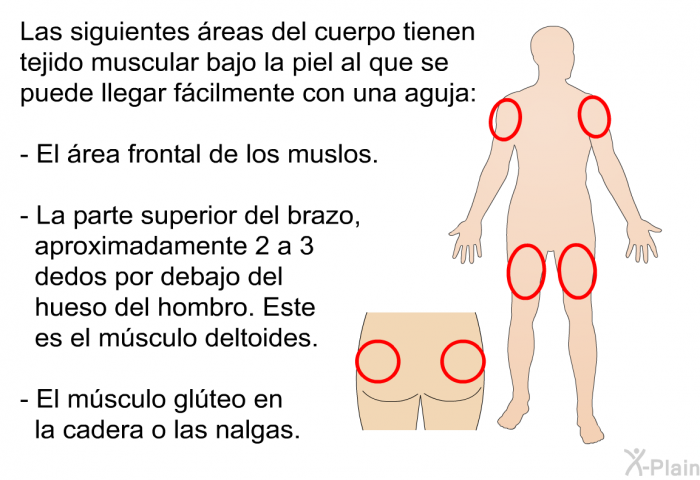 Las siguientes reas del cuerpo tienen tejido muscular bajo la piel al que se puede llegar fcilmente con una aguja:  El rea frontal de los muslos La parte superior del brazo, aproximadamente 2 a 3 dedos por debajo del hueso del hombro. Éste es el msculo deltoides.    El msculo glteo en la cadera o las nalgas.