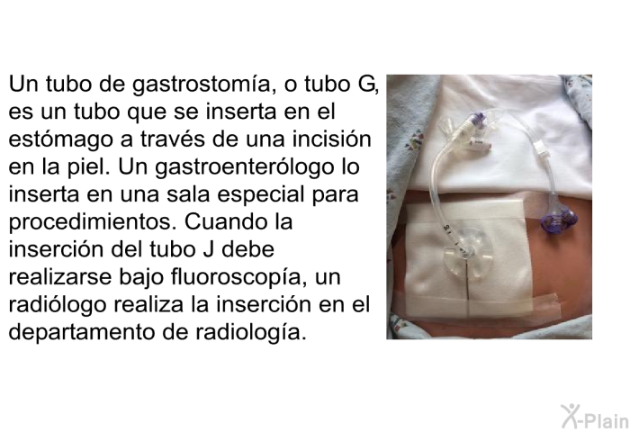 Un tubo de gastrostoma, o tubo G, es un tubo que se inserta en el estmago a travs de una incisin en la piel. Un gastroenterlogo lo inserta en una sala especial para procedimientos. Cuando la insercin del tubo J debe realizarse bajo fluoroscopa, un radilogo realiza la insercin en el departamento de radiologa.