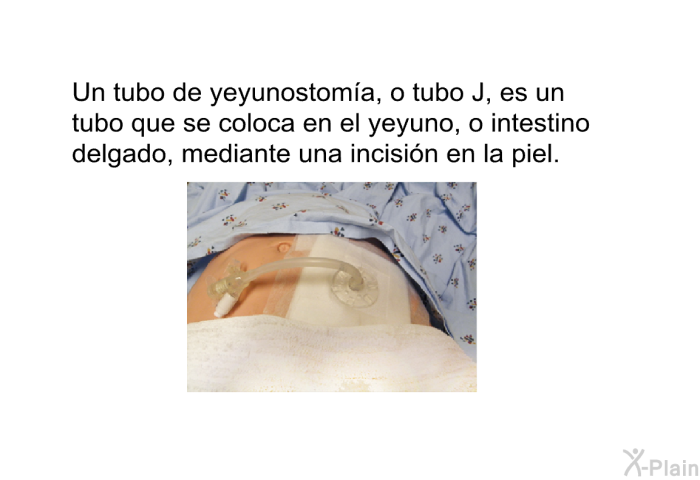 Un tubo de yeyunostoma, o tubo J, es un tubo que se coloca en el yeyuno, o intestino delgado, mediante una incisin en la piel.