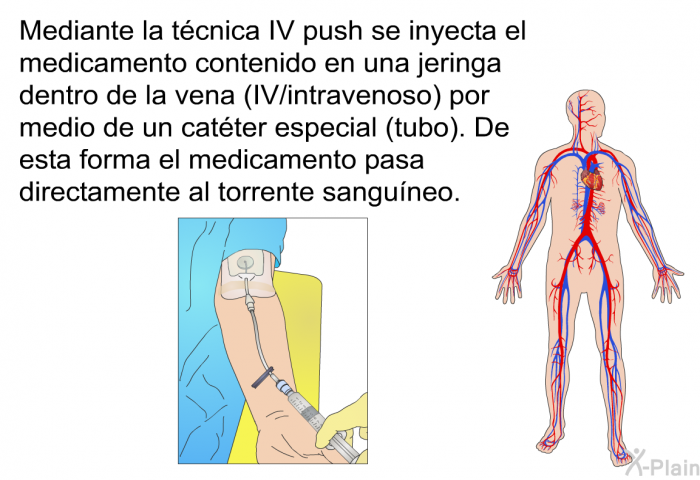 Mediante la tcnica IV push se inyecta el medicamento contenido en una jeringa dentro de la vena (IV/intravenoso) por medio de un catter especial (tubo). De esta forma el medicamento pasa directamente al torrente sanguneo.