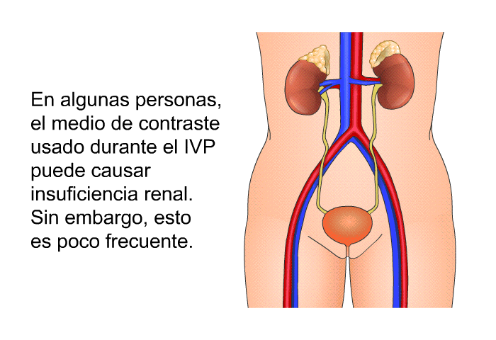 En algunas personas, el medio de contraste usado durante el IVP puede causar insuficiencia renal. Sin embargo, esto es poco frecuente.