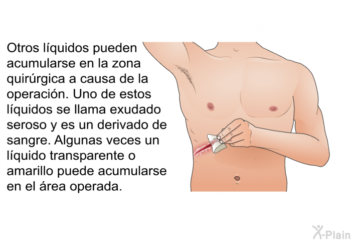 Otros lquidos pueden acumularse en la zona quirrgica a causa de la operacin. Uno de estos lquidos se llama exudado seroso y es un derivado de sangre. Algunas veces un lquido transparente o amarillo puede acumularse en el rea operada.